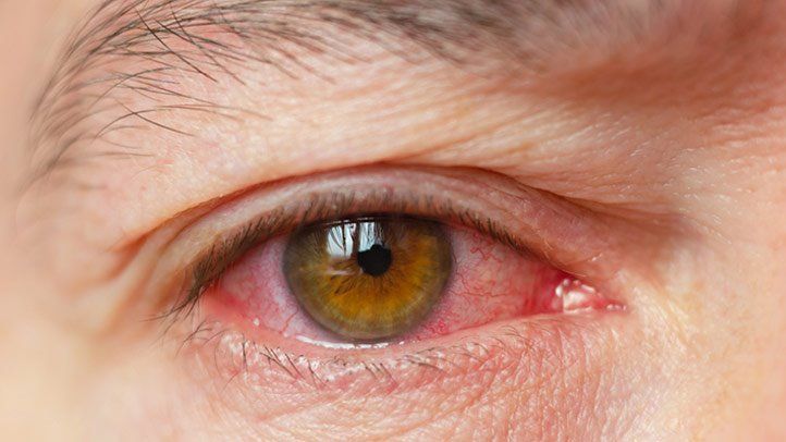 Common causes of dry eye pain