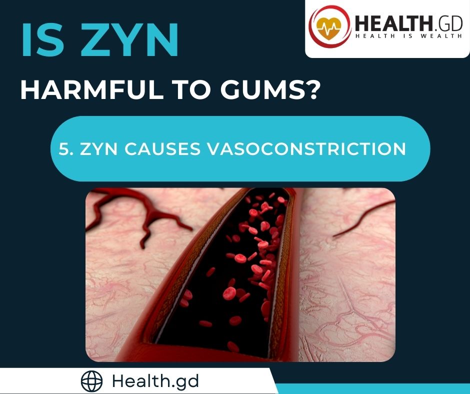 Is ZYN harmful to Gums ZYN Causes Vasoconstriction
