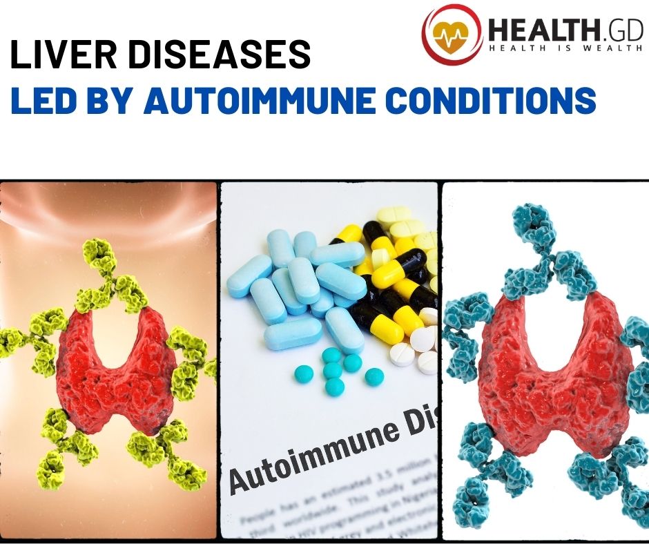 Liver Diseases by Autoimmune Conditions