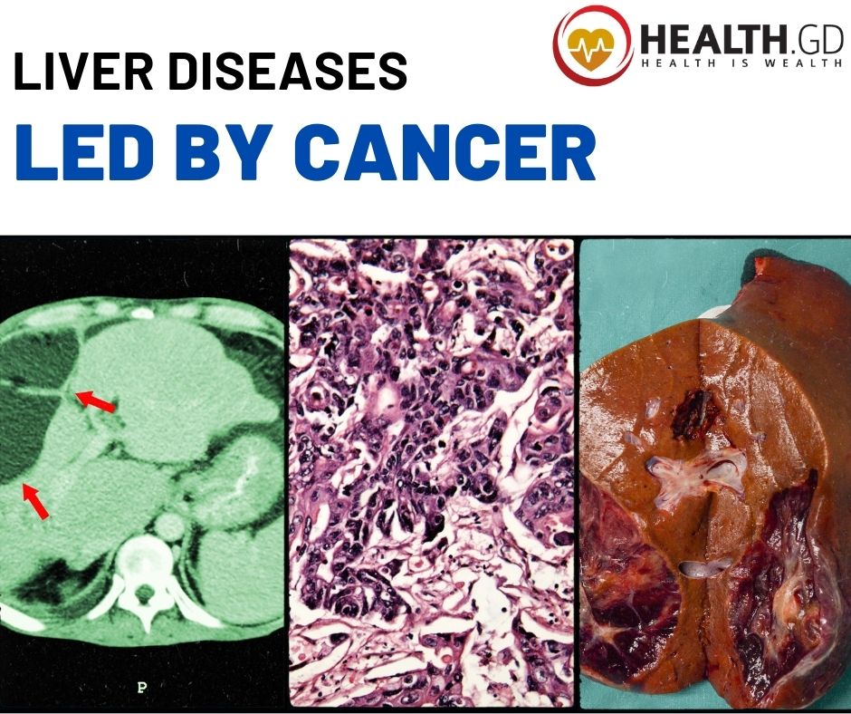 Liver Diseases by Cancer