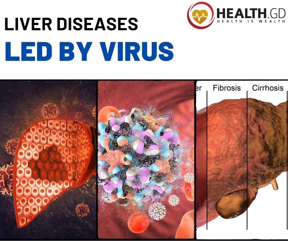 Liver Diseases by virus