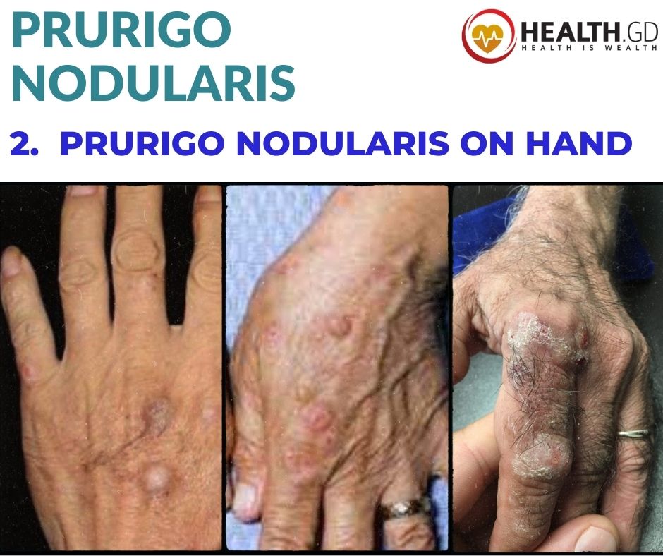 Pictures Of Prurigo Nodularis On Hand