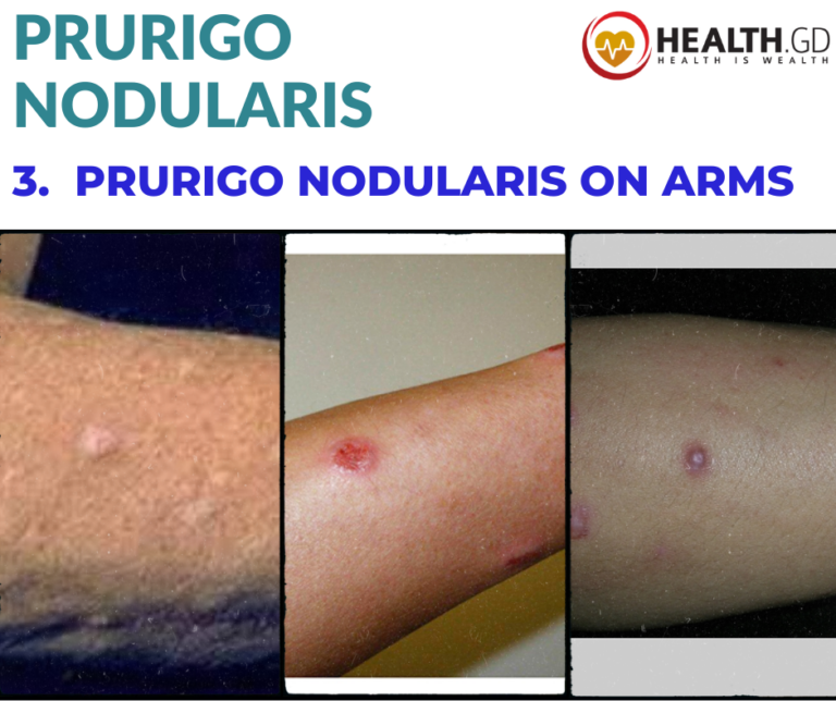 12 Pictures Of Prurigo Nodularis Diagnosis And Treatment Healthgd
