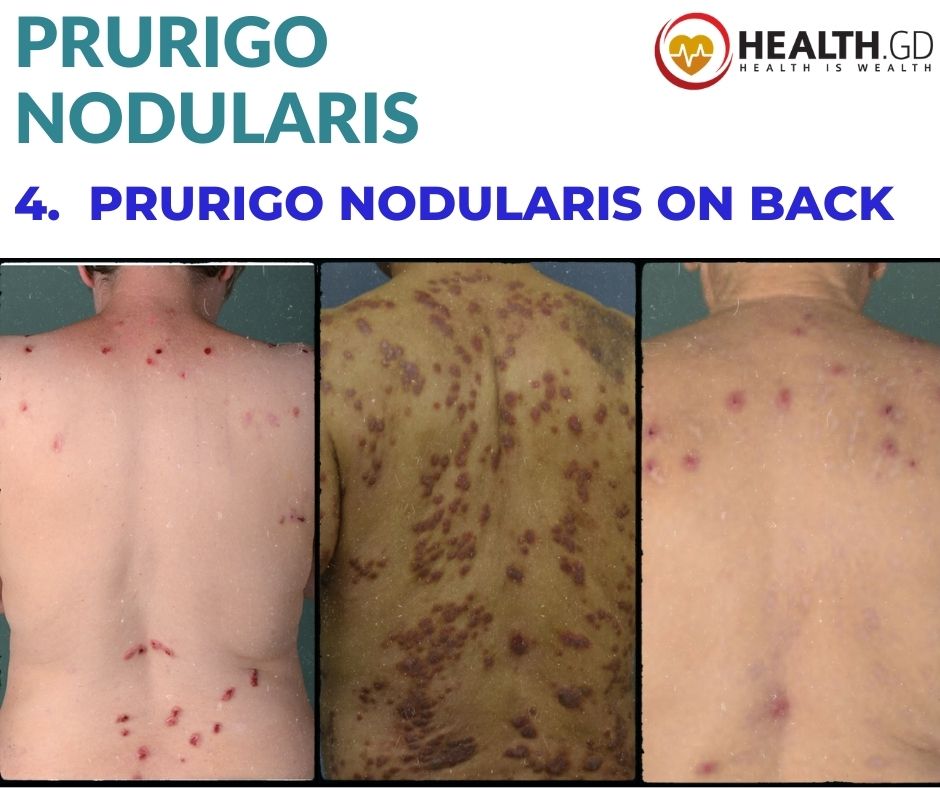 Pictures Of Prurigo Nodularis On back