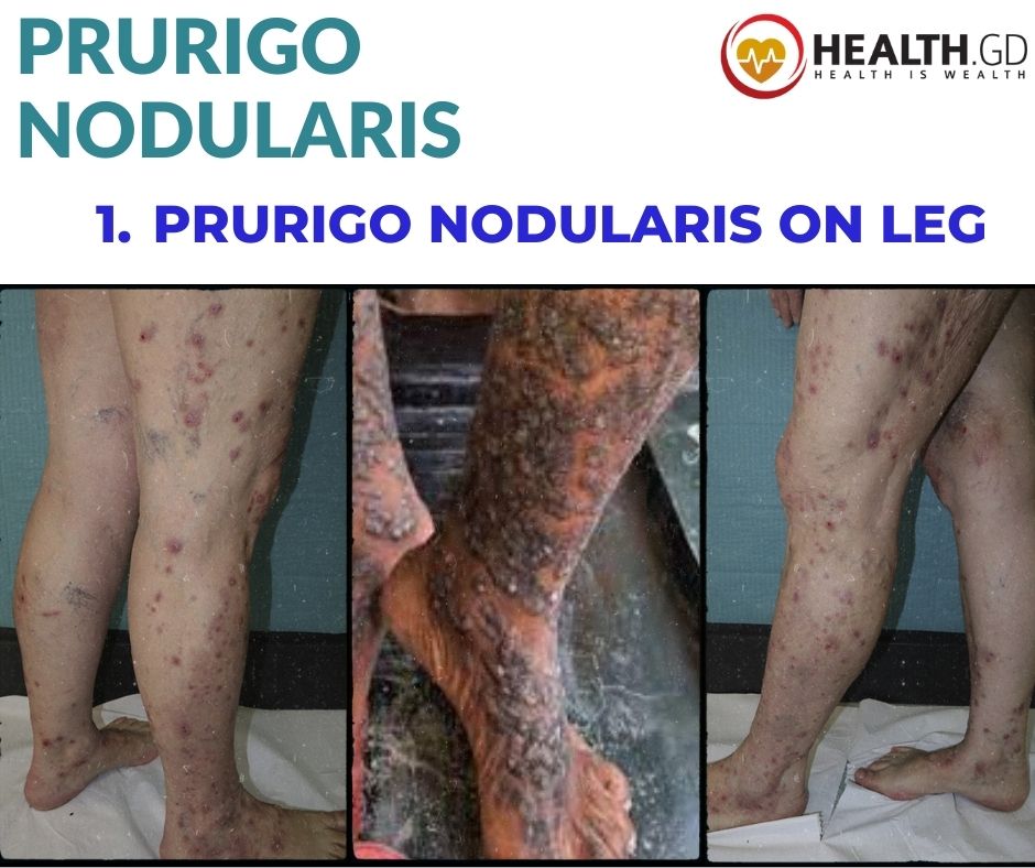 Pictures Of Prurigo Nodularis on leg