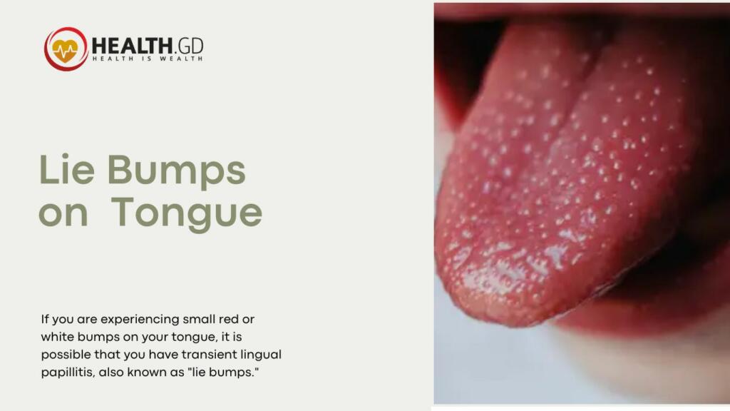 what is a lie bump on the tongue