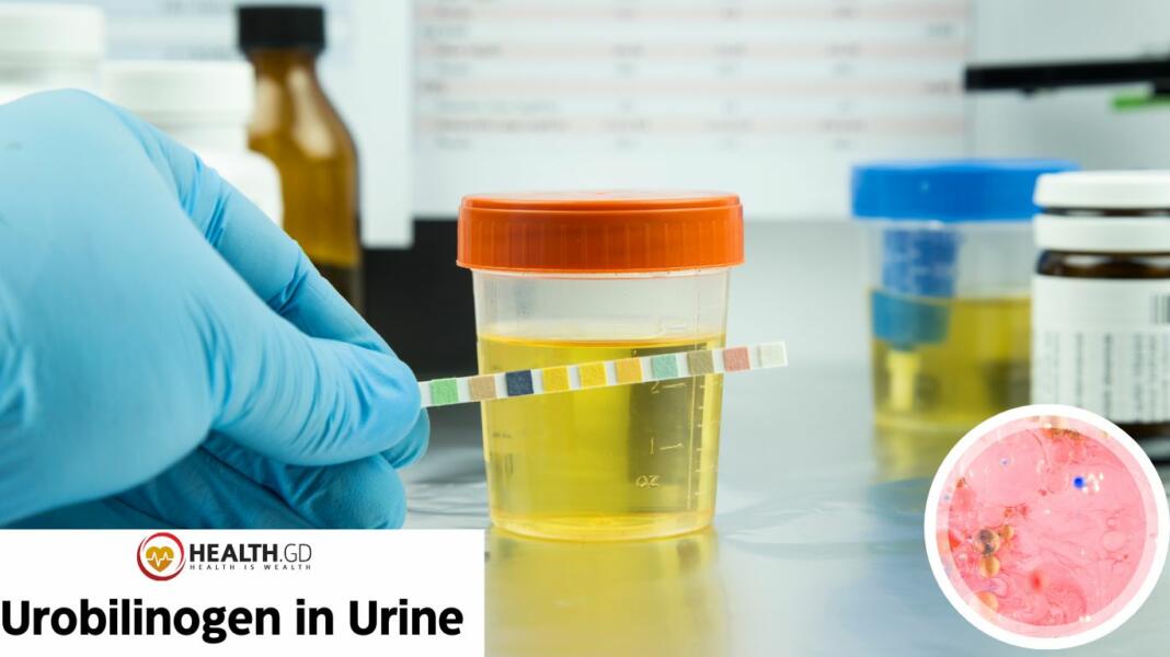 Found Excess Urobilinogen In Urine Solution Is Here Healthgd 9590